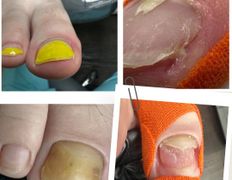 Центр подологии и эстетики Чистая стопа, Подология - фото 6