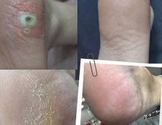 Центр подологии и эстетики Чистая стопа, Подология - фото 7