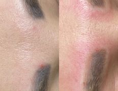 null Студия перманентного макияжа Алексея Набедо, Удаление перманентного макияжа - фото 1