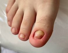 Студия подологии и эстетики  Moipodolog (Мой подолог), Подология - фото 8