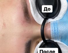 null Студия перманентного макияжа Алексея Набедо, Удаление перманентного макияжа - фото 5