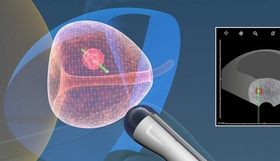 Биопсия предстательной железы