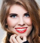 Титановые брекеты
