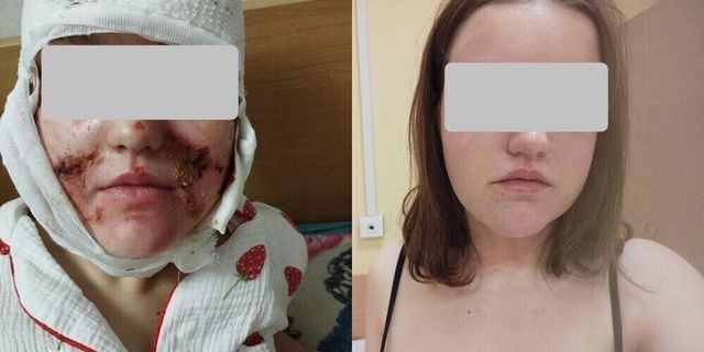 Косметика довела школьницу до реанимации: в Гродно 13-летняя девочка получила химический ожог лица