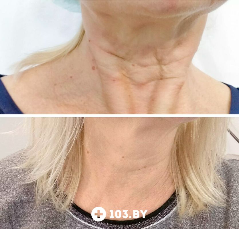 Инъекционные процедуры Салон красоты «ORIENTAL (Ориентал)» - фото 2781516