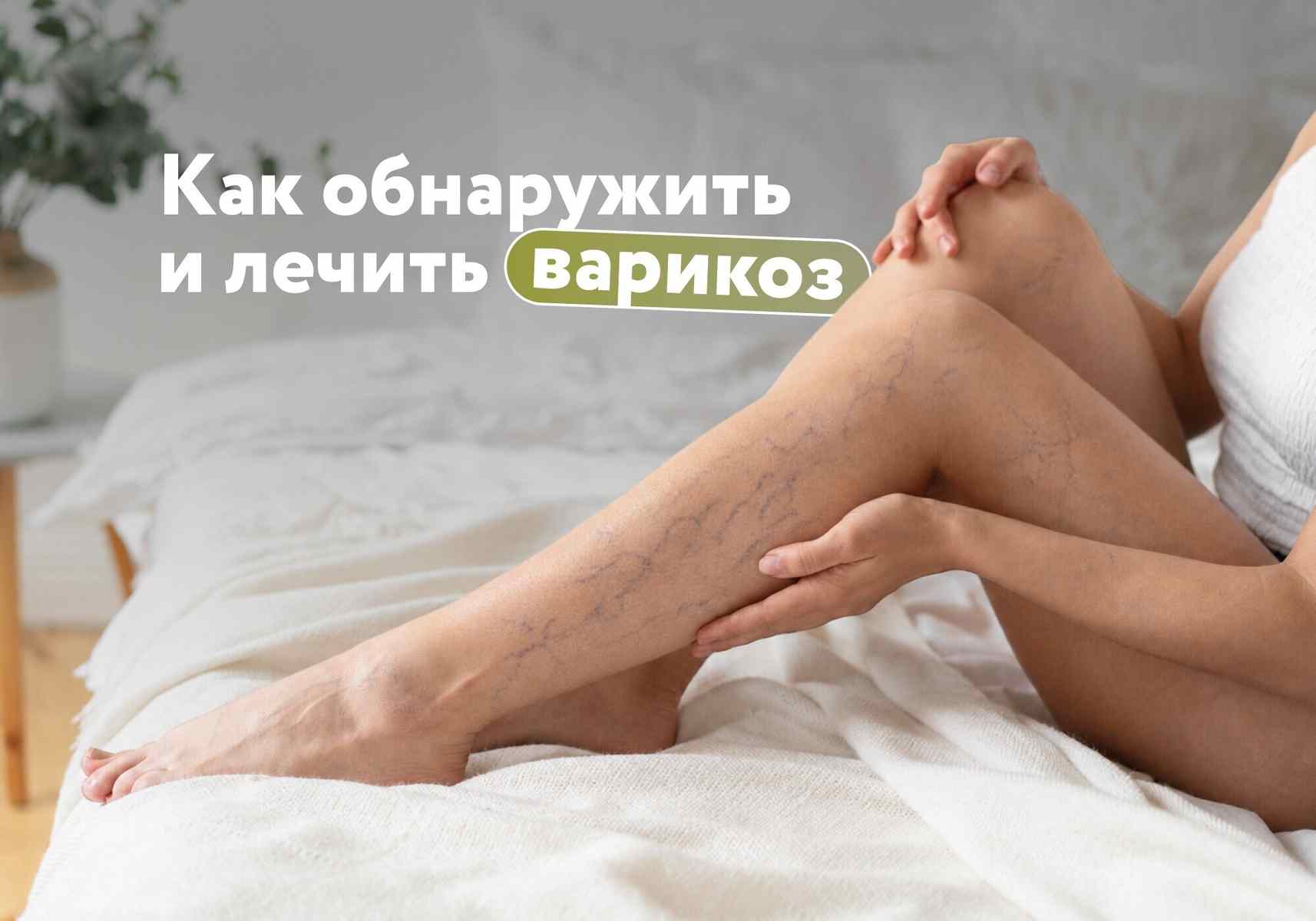 Почему так важно принимать венотоники на всех стадиях варикозной болезни?