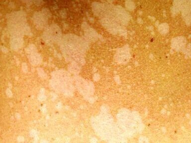 Отрубевидный лишай