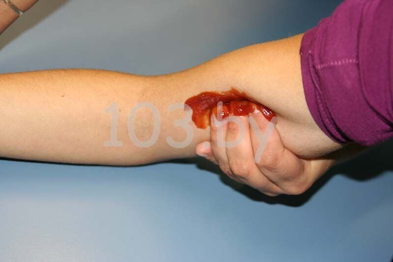 остановка кровотечения из руки рука сверху.JPG