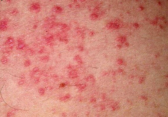 Фото атопического дерматита