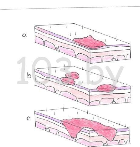 ожоги. глубина ожога.jpg