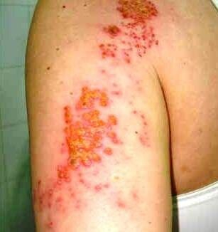 Опоясывающий лишай фото