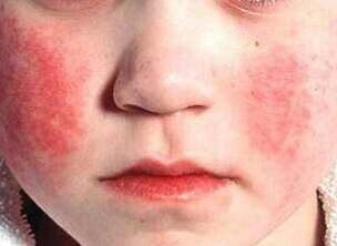 Краснуха у детей: фото, симптомы, лечение