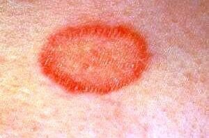 Как выглядит розовый лишай