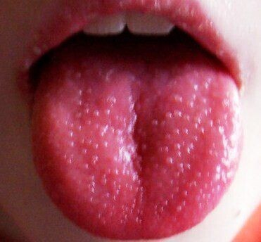 Скарлатина у детей фото, симптомы, лечение