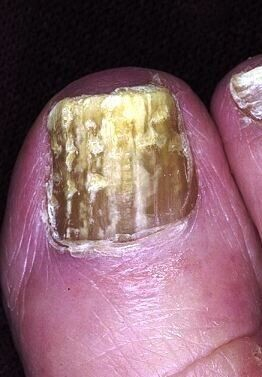 Грибок ногтей на ногах