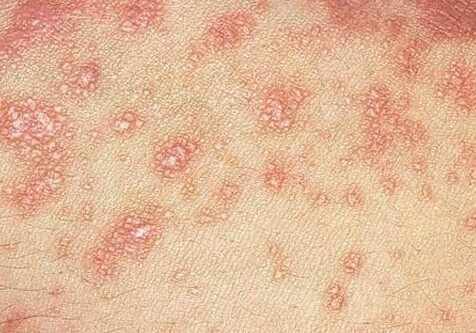 Красный плоский лишай у человека