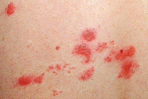 Опоясывающий лишай у человека