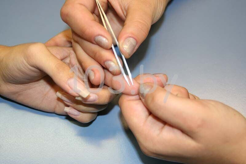 удаление заноз1.JPG удаление заноз1.JPG