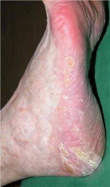 Грибок стопы фото