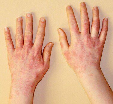 Аллергический дерматит