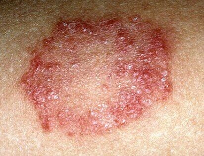 Розовый лишай у человека