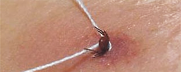 Как правильно вытащить клеща