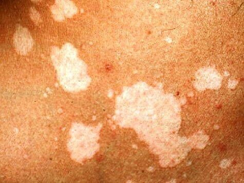 Отрубевидный лишай у человека