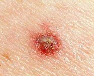 Как выглядит укус клеща фото