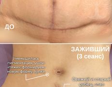 Студия красоты INTUITION (Интуишн), Холодная плазма - фото 3