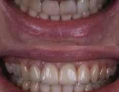 Стоматология Триомед, Примеры работ (ортопедия) - фото 5