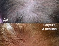 Студия красоты INTUITION (Интуишн), Холодная плазма - фото 1