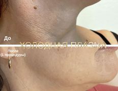 Студия красоты INTUITION (Интуишн), Холодная плазма - фото 2