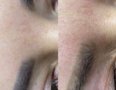 null Студия перманентного макияжа Алексея Набедо, Удаление перманентного макияжа - фото 2