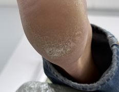 Студия подологии и эстетики IloNails studio (ИлоНеилс студио), Подология - фото 12