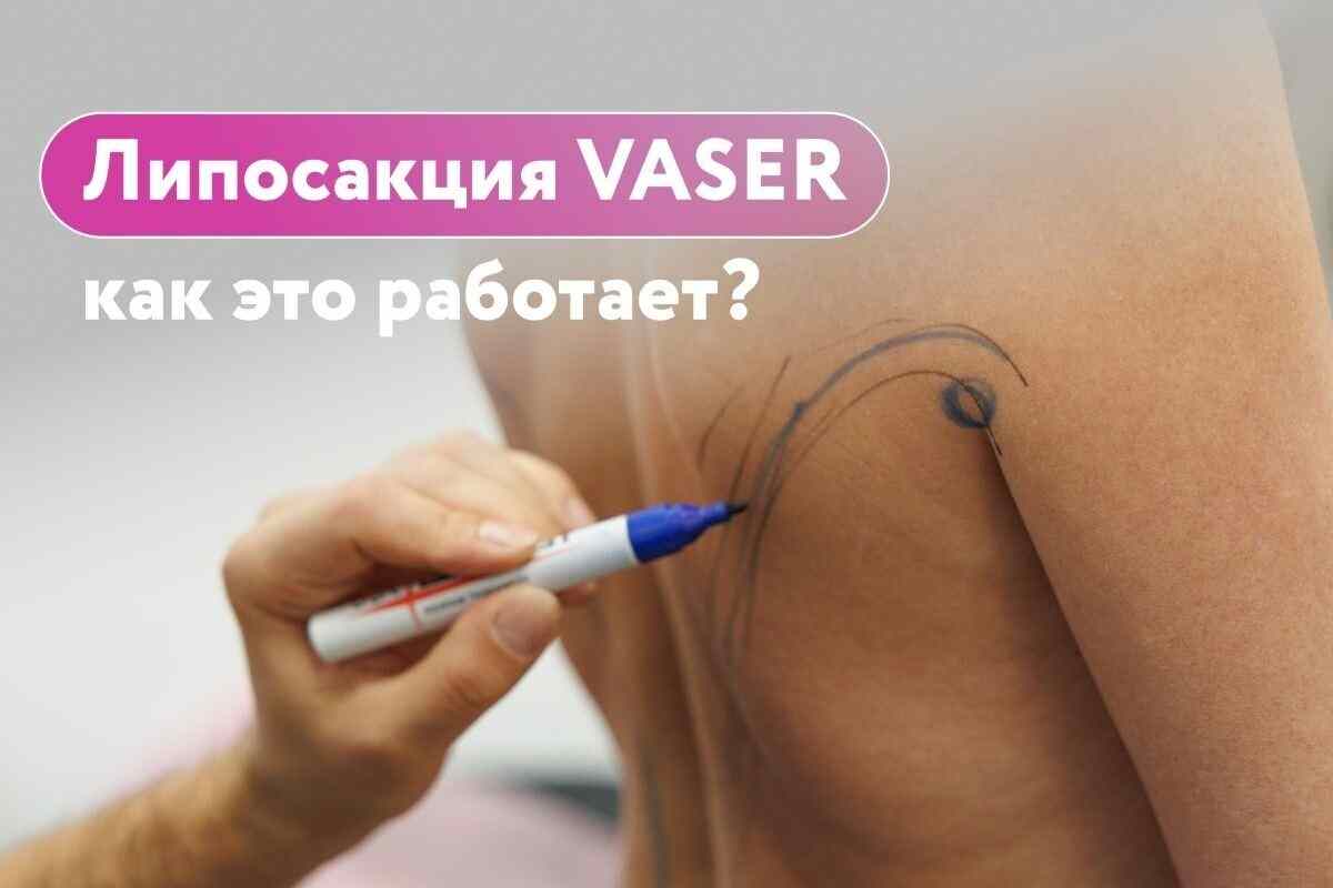Липосакция VASER в Беларуси: как ультразвук помогает убрать локальный жир и сформировать контуры