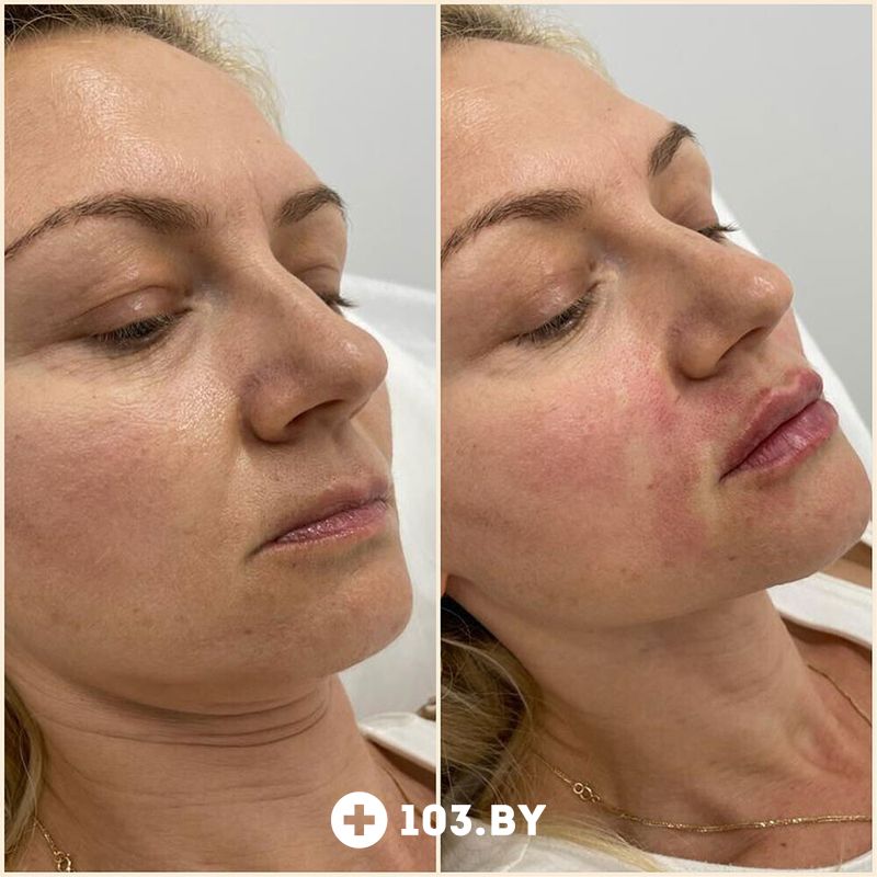 Инъекционные процедуры Салон красоты «ORIENTAL (Ориентал)» - фото 2781483