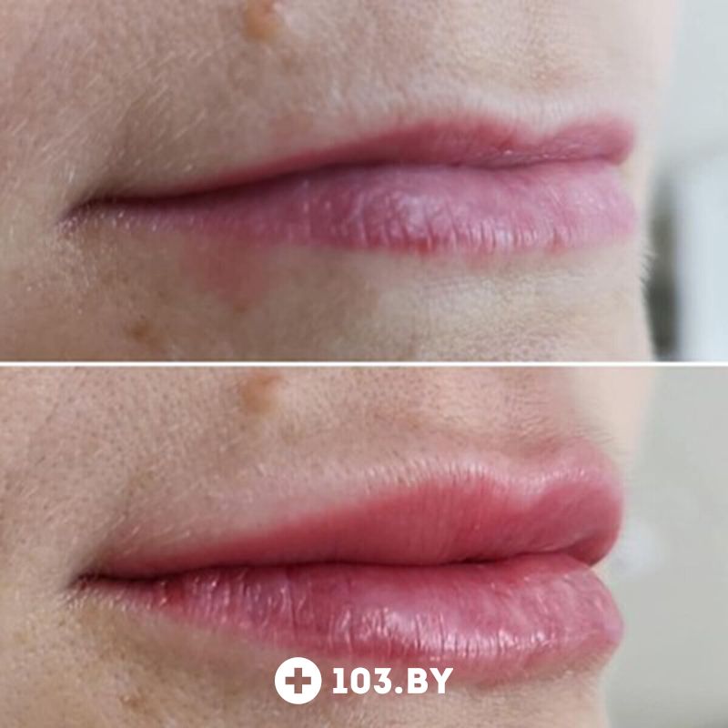 Инъекционные процедуры Салон красоты «ORIENTAL (Ориентал)» - фото 2781510